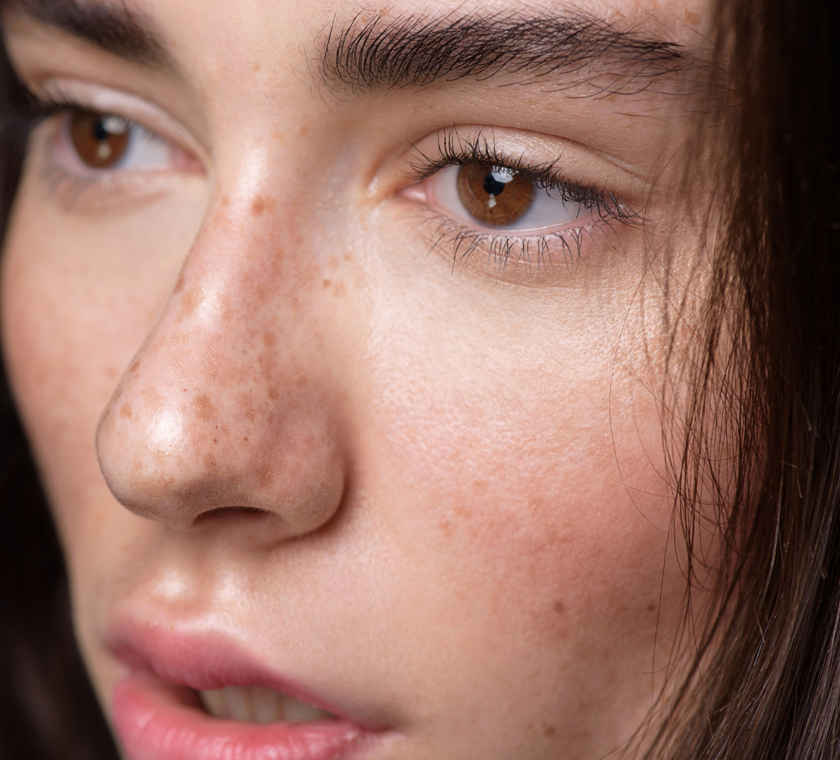 Beyond the Blush: Navigating Rosacea