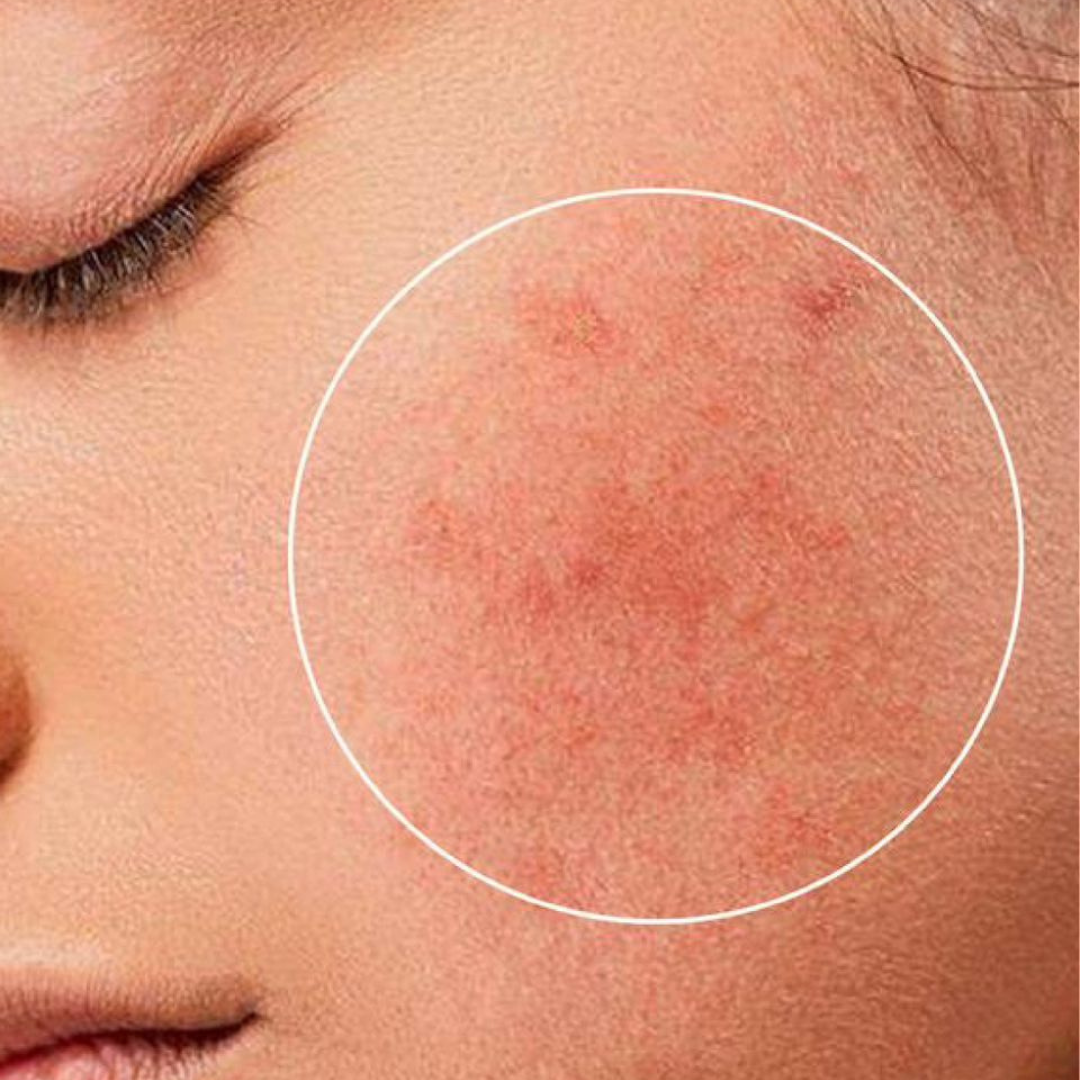 Type 2 Rosacea: Everything You Need to Know
